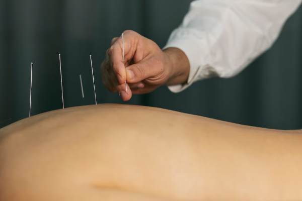 Akupunktur