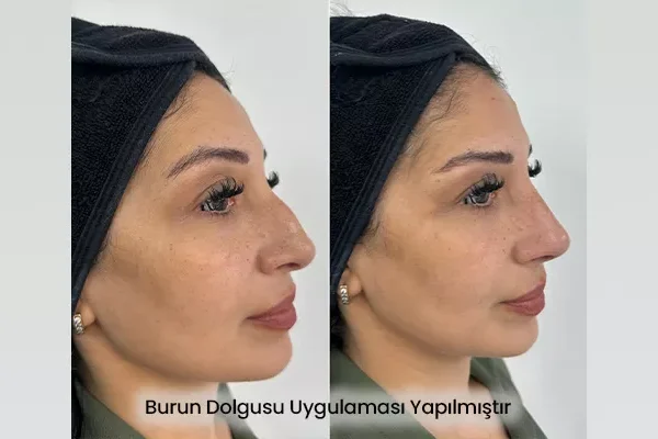 Burun Dolgusu