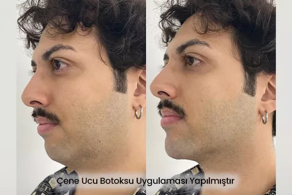 Çene Hattı Belirginleştirme