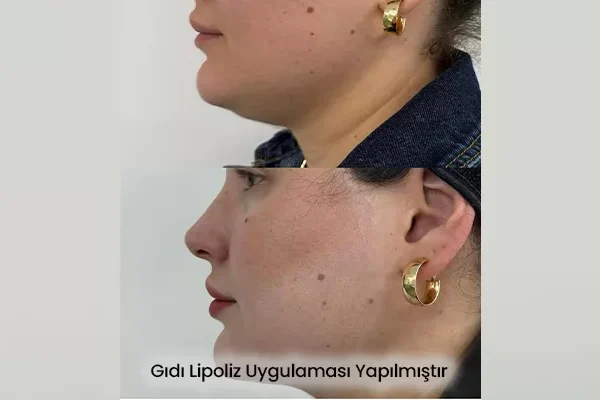 Gıdı Lipoliz