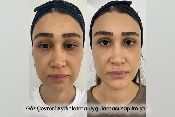 Göz Çevresi Aydınlatma
