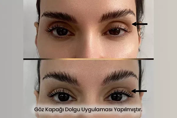 Göz Kapağı Dolgusu