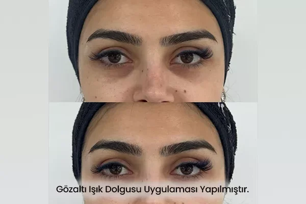 Göz Altı Işık Dolgusu