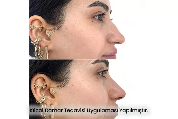 Kılcal Damar Tedavisi