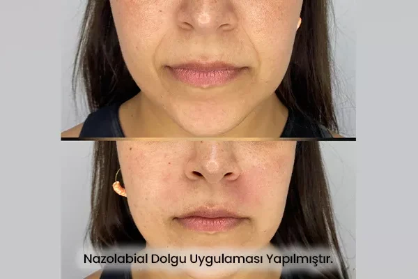 Nazolabial Dolgu