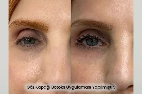 Plexr ile Göz Kapağı Sıkılaştırma