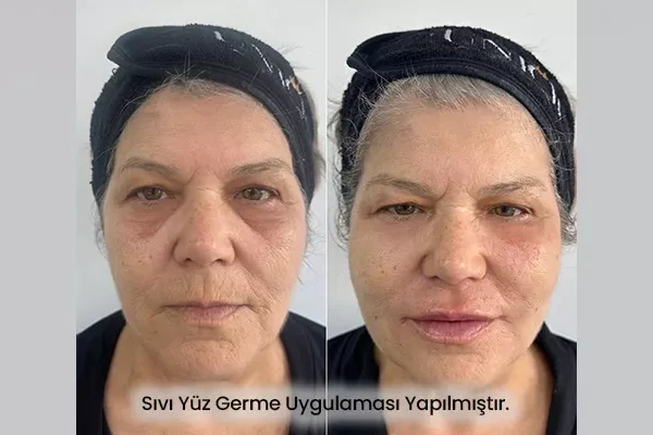 Sıvı Yüz Germe